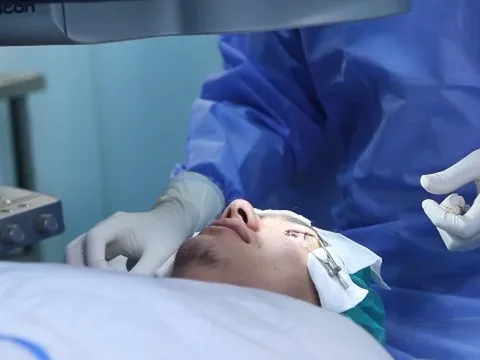 Ilustrasi tindakan LASIK