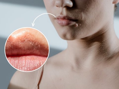 Bintik Putih di Bibir Seperti Jerawat Ternyata Fordyce spots