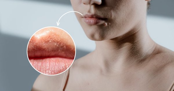 Bintik Putih di Bibir Seperti Jerawat Ternyata Fordyce spots