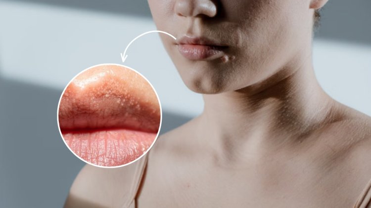 Bintik Putih di Bibir Seperti Jerawat Ternyata Fordyce spots