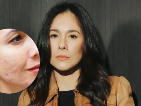 Wulan guritno kulit bertekstur bekas jerawat