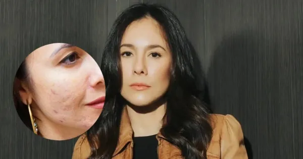 Wulan guritno kulit bertekstur bekas jerawat Wulan guritno kulit bertekstur bekas jerawat